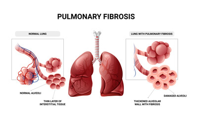 Pulmonary fibrosis and normal lung tissue infographic. Vector illustration isolated on white background