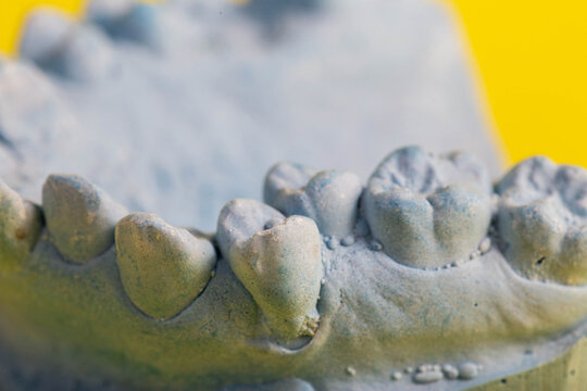 Blue plaster model of an impression of a patient s jaw at an orthodontist s dentist, close-up. Crooked teeth, correction of malocclusion, macro