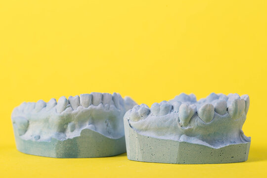Blue plaster impression of a patient's dental jaw with crooked teeth and malocclusions on a yellow background. Manufacturing of bridges, crowns of various types, macro. 