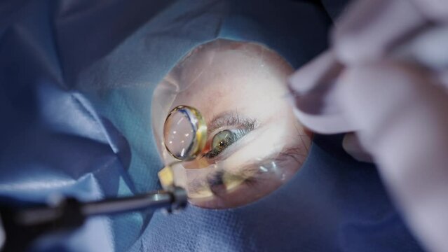 Vision correction with microscope. Surgeon's hands in gloves performing laser eye vision correction. ophthalmology , medicine, people health concept. High quality 4k footage