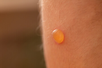 Macro of a small round blister on a skin after burn. Male leg, many tiny hairs, scald close up