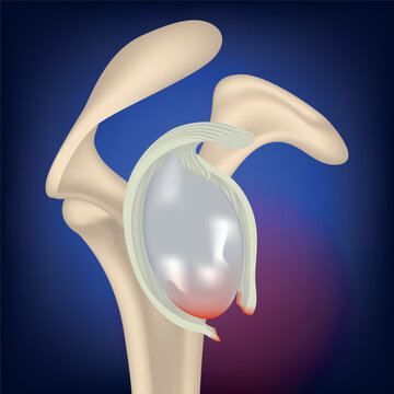rupture of the clavicular cavity. Rendering of a collarbone on a blue neon background. Medical banner. Vector illustration
