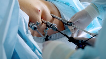 Operating room, team of surgeons performing laparoscopic intervention. Modern medicine, medical...