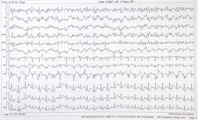 ECG electrocardiogram of a cardiac person, heart disease - obrazy, fototapety, plakaty