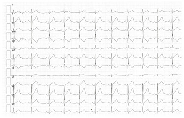 Rhythm of heart on graph using for fetal heart monitoring. Electrocardiogram in paper form.