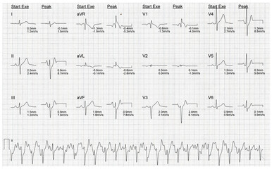 Rhythm of heart on graph using for fetal heart monitoring. Electrocardiogram in paper form.