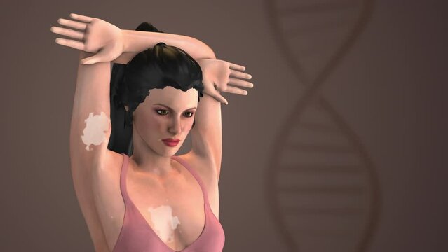 3d animation of the vitiligo skin disease