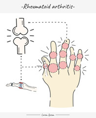 Rheumatoid arthritis illustration