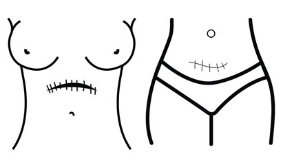 Transverse incision line icon. Abdominal incisions.
Scars line icon in vector, c-section scar illustration