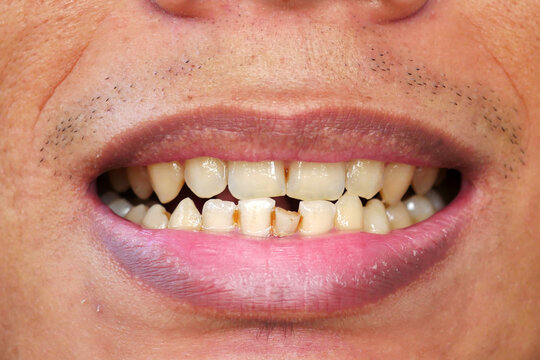 Detailed image of a man's mouth with yellow, untidy teeth and chapped lips, black lips. Dental and oral health care. Dental hygiene. Dentistry and mouth