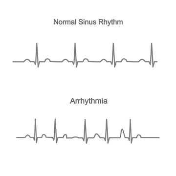 The electrocardiogram or Electrocardiography (ECG or EKG) of Normal Sinus Rhythm and  Arrhythmia.