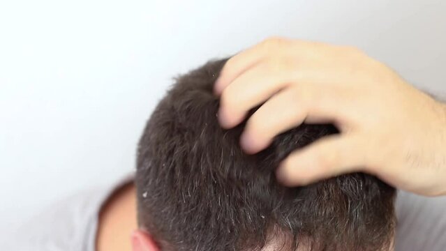 Dandruff on the hair. Hair disease seborrhea. Fatty Dandruff.