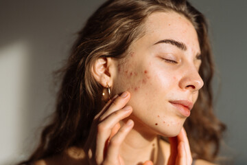 Obraz premium Young Woman with a problem skin. Treatment for acne. Dermatology, cosmetology, skin care.