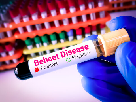 Blood sample for Behcet's disease (BD) test, HLA B51 (human leukocyte antigen).