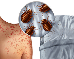 Bedbug bites rash or bedbug infestation concept as a magnification close up of  parasitic insect pests as a hygiene symbol and health danger of bloodsucking parasites