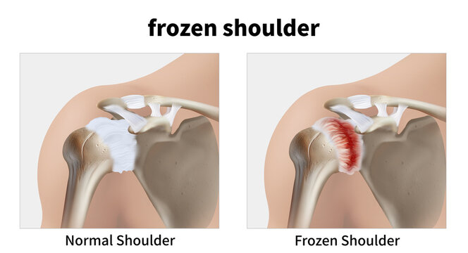 Medical illustration explaining frozen shoulder
