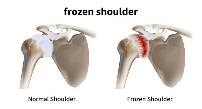 Medical illustration explaining frozen shoulder