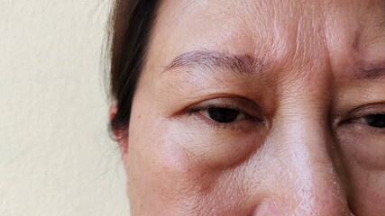 close up the wrinkle and Flabby skin beside the eyelid, dark spots and blemish, swelling and loose on the face of the woman, health care and beauty concept.