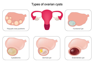 Types of ovarian cysts vector. Polycystic ovary syndrome, Cystadenoma, Dermoid cyst, Endometriotic cyst and Functional Cyst.