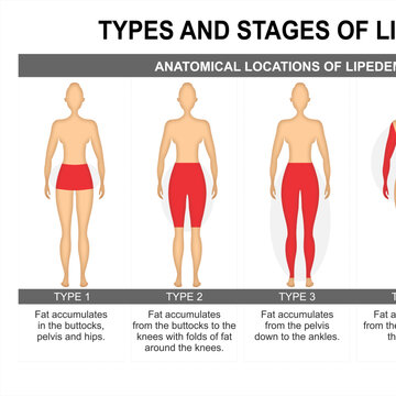 Types of Lipedema Medical Educational Illustration
