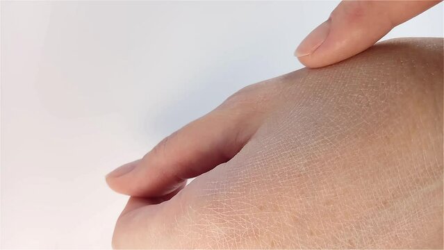 Dry hand skin. A woman shows her hand with cracked dry problem skin. Close-up view. Dermatological treatment, body and healthcare, hygiene and medicine concept