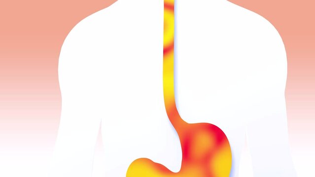 3d animation of stomach and esophagus with fire. Burning and reflux. Showing the anatomical interior of the human digestive system, on white background.