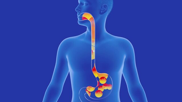 Anatomical 3D animation of the stomach and esophagus with reflux to the mouth. With ardor and circles of fire. Digestive system and transparent human figure on blue background.