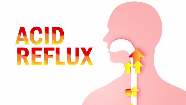 3d animation of esophagus with gastric reflux and heartburn. With arrows, circles and the word "acid reflux" of fire. Digestive system and human silhouette on white background.