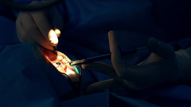 Doctor applies surgical tools in the patient's eye. Surgeon works in the dark operational room. Close up.