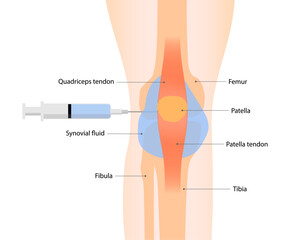 Knee arthrocentesis or synovial fluid aspiration for relieve pain and swelling caused by conditions like arthritis or injury. Medical procedure vector illustration isolated on white background.