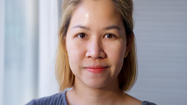 Syringoma milia milium cysts or seborrheic keratosis on asia people female face body care. Close-up young adult asian woman under eye small acne liver spot skin issue smile with pride look at camera.