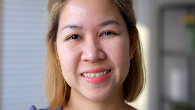 Syringoma milia milium cysts or seborrheic keratosis on asia people female face body care. Close-up young adult asian woman under eye small acne liver spot skin issue smile with pride look at camera.