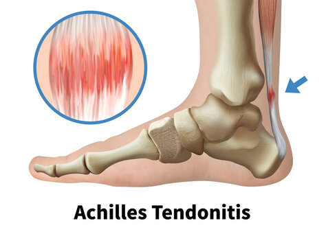 Foot medical illustration illustrating Achilles tendonitis