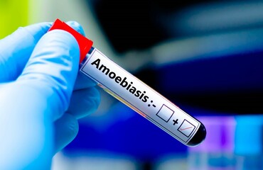 Fototapeta premium Blood sample of patient positive tested for amoebiasis.