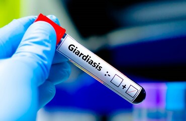 Obraz premium Blood sample of patient positive tested for giardiasis.