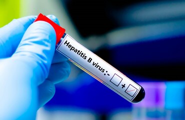 Fototapeta premium Blood sample of patient positive tested for hepatitis B virus.