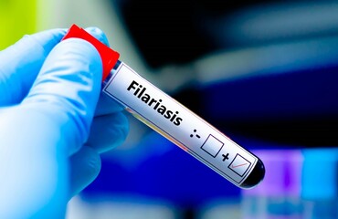 Fototapeta premium Blood sample of patient positive tested for filariasis.