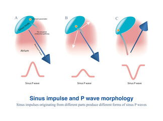 Sinus impulses from different parts of the sinoatrial node produce different patterns of atrial excitation and potential, resulting in diversified sinus P wave morphology.
