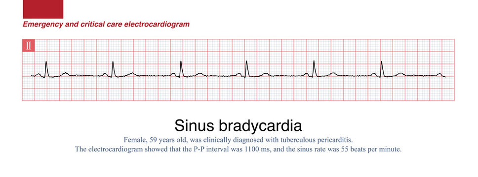When the frequency of sinus rhythm is less than 60 beats per minute, it is called sinus bradycardia. Severe sinus bradycardia should be suspicious of sick sinus syndrome.
