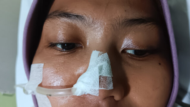 Nasogastric tube in patient