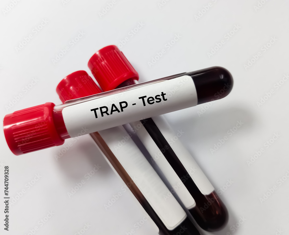 Canvas Prints Blood sample for Tartrate resistant acid phosphatase (TRAP) test in laboratory for the diagnosis of hairy cell leukemia.