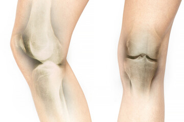 Female legs with x-ray of the patella with overlay effect on white, knee pain, knee pain, patella...