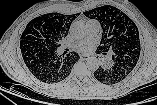 Chest CAT- SCAN that shows a hamartoma tumor on the left lung. Medical themes
