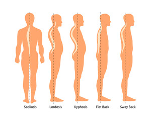 Medical illustration of spinal deformity types: scoliosis, lordosis and kyphosis, Sway back. Body posture defect. Infographics of spine diseases. - obrazy, fototapety, plakaty