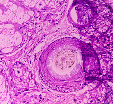 Mature cystic teratoma, Ovarian cyst biopsy, show cyst wall of skin and adnexal structure, fatty tissue, salivary acini and cartilage. Cystic teratoma of dermoid cyst.