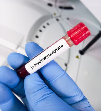 Blood sample for Beta-Hydroxybutyrate (BHB) test. used to detect ketones to identify patients suffering from diabetic ketoacidosis.