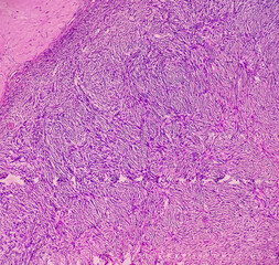 Uterus with adnexa (biopsy): Cervix show chronic inflamatory cells, wall show secretory phase in endometrium and fallopian tube show paratubal cyst. fimbrial cyst, Paraovarian cyst.