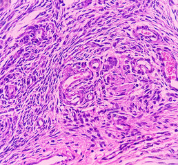 Uterus with adnexa (biopsy): Cervix show chronic inflamatory cells, wall show secretory phase in endometrium and fallopian tube show paratubal cyst. fimbrial cyst, Paraovarian cyst.