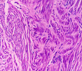 Uterus with adnexa (biopsy): Cervix show chronic inflamatory cells, wall show secretory phase in endometrium and fallopian tube show paratubal cyst. fimbrial cyst, Paraovarian cyst.