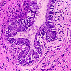 Uterus with adnexa (biopsy): Cervix show chronic inflamatory cells, wall show secretory phase in endometrium and fallopian tube show paratubal cyst. fimbrial cyst, Paraovarian cyst.